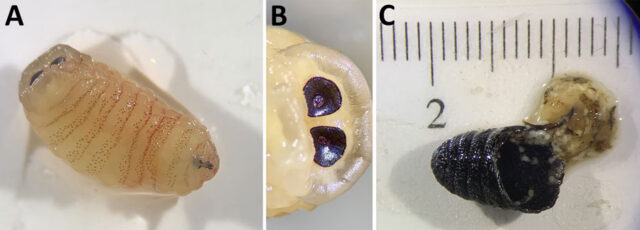 Woman sneezes out maggots after fly larvae get trapped in her deviated septum