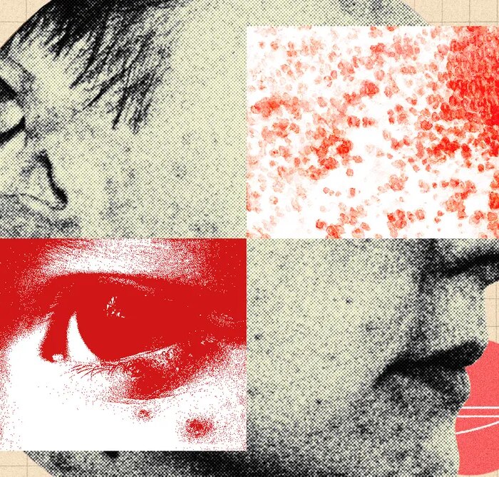 You Should Be More Freaked Out by Shingles